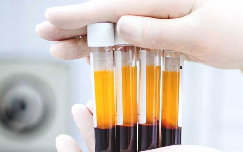 Plasma Rico em Plaquetas (PRP): Da Estética à Reabilitação Articular